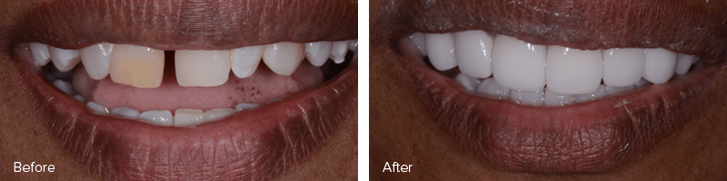 Full Mouth Restoration Before and After Image of A Real Patient 