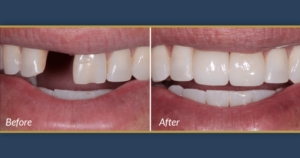 Before and after photos of teeth showing that dental implants are not painful.