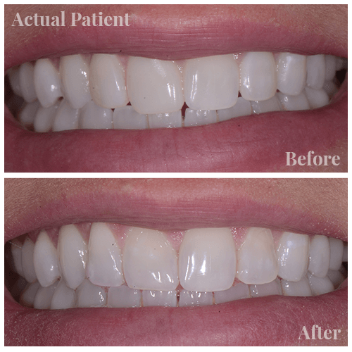 Close up of before and after a cosmetic bonding procedure