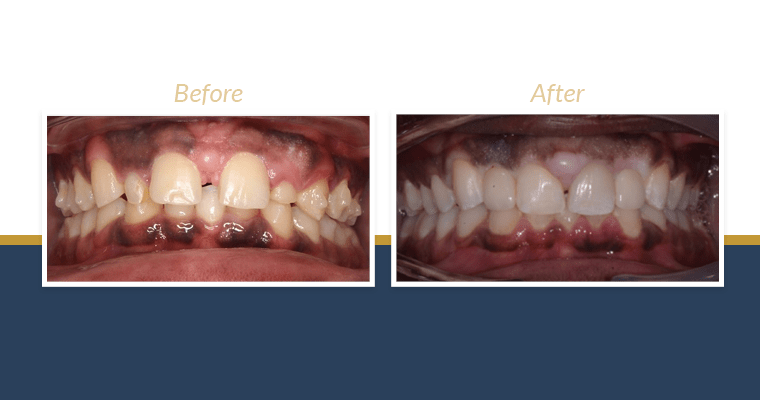 before and after Invisalign treatment of a smile with gaps and baby teeth