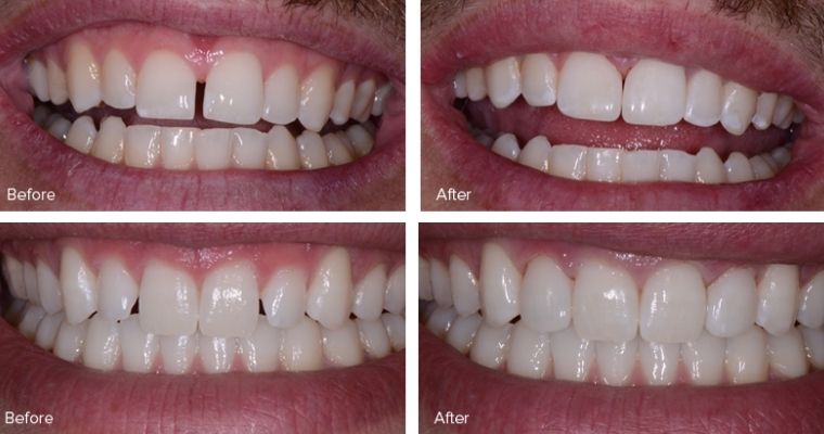 Patient smiles before and after cosmetic bonding.