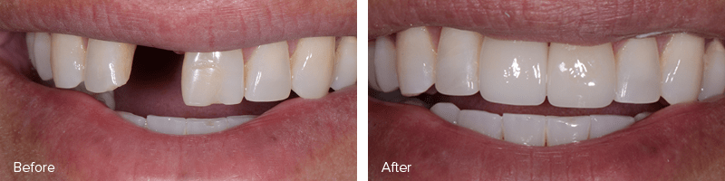 Patient with dental implant restoration.