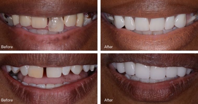 Patients smile gap fixed with porcelain veneers. 