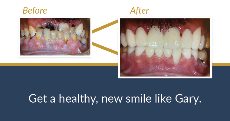Complete before and after photo of a patient’s teeth. 